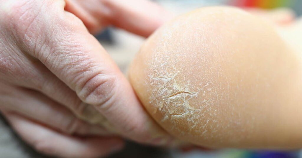 Hälsprickor – sprickor och brister i huden på hälen