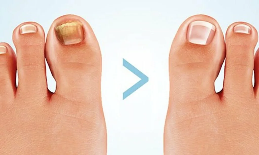 Behandling av kala naglar