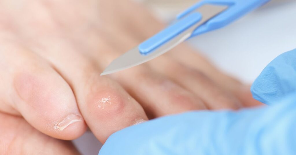 Förhårdnad – liktorn på fot