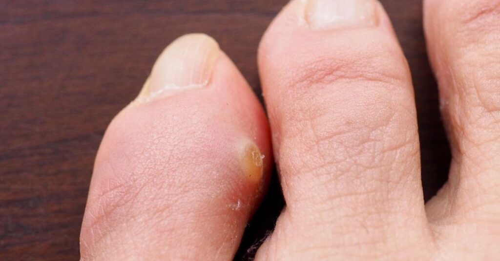 Förhårdnad behandling – fotvård och förebyggande